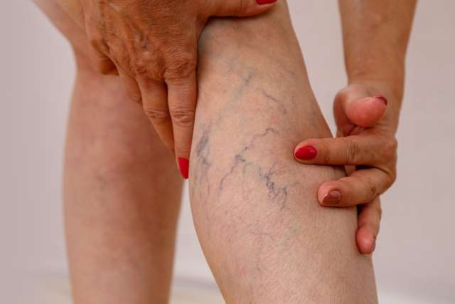 Varicose-Veins-Banner