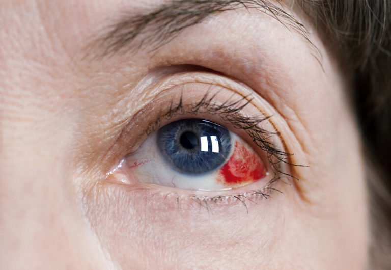 ocular-hypertension-a-precursor-to-glaucoma-768x530
